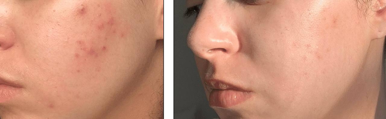 Acne correction · staged protocol