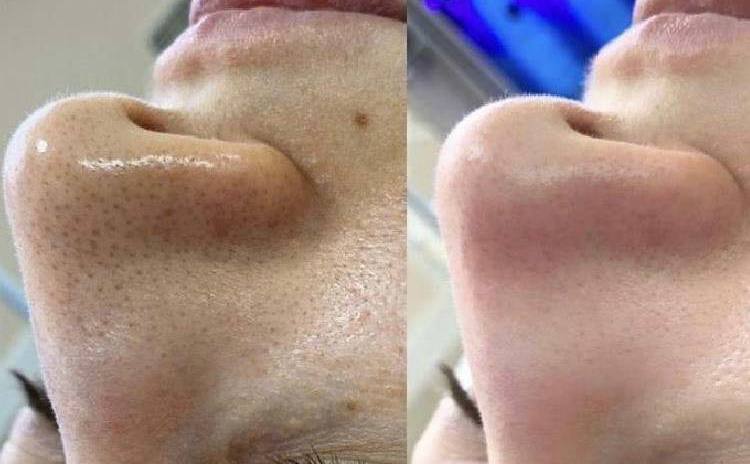 Deep Combined Facial Cleansing