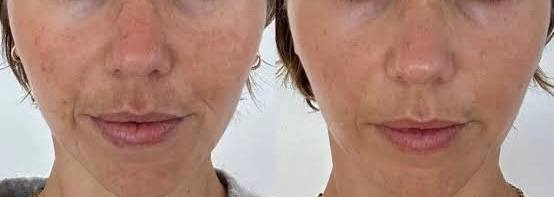 Microneedling with PDRN (Salmon DNA)