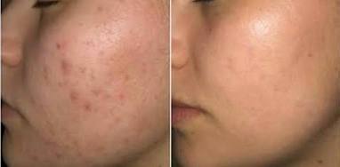 Post-acne pigmentation